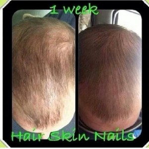 hairgrowth 6